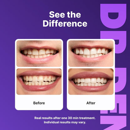 Bright Smile Whitening Strips